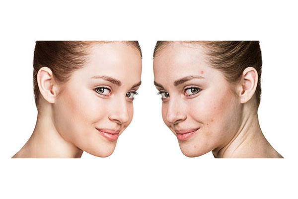 Acne Treatment and Acne Removal with The Best Clinics in Singapore