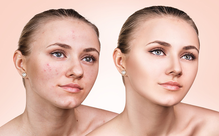 Acne-treatment