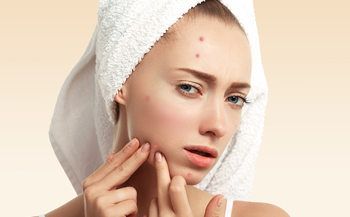 Acne-treatment