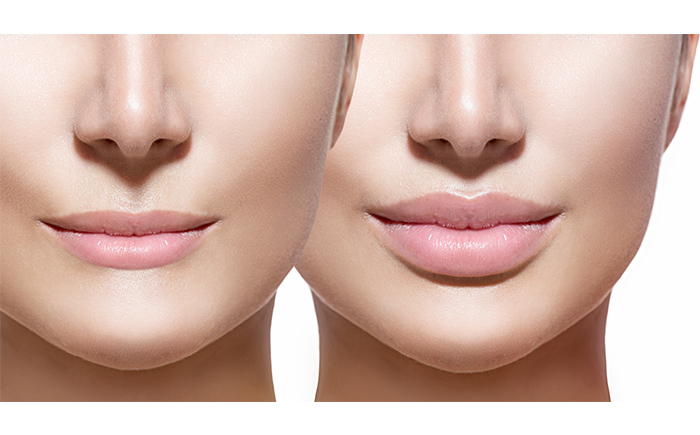 dermal-lip-filler